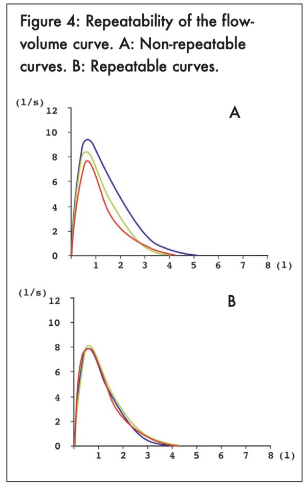 Figure 4: Repeatability of the flow-volume curve. A: Non-repeatable curves. B: Repeatable curves - click to enlarge Figure 4: Repeatability of the flow-volume curve. A: Non-repeatable curves. B: Repeatable curves - click to enlarge